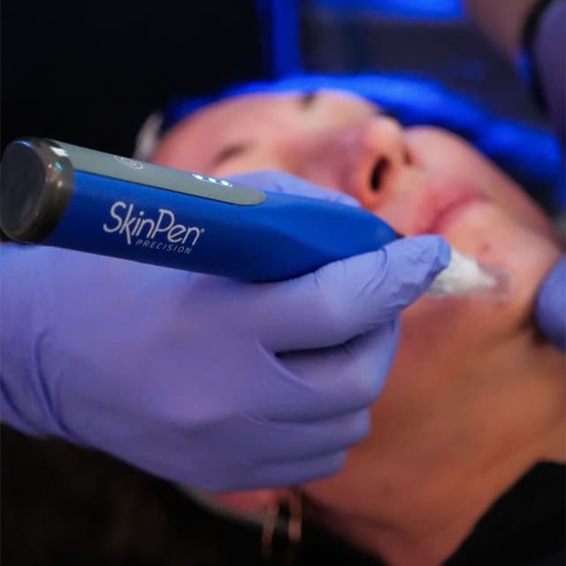 Microneedling - Series of 3 at Dual Aesthetics in Gilbert, AZ